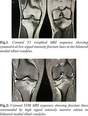 medial tibial stress fracture