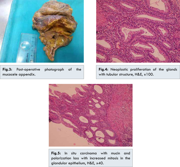 Mucocele Of Appendix Vermiformis Due To Mucinous Cystadenoma With